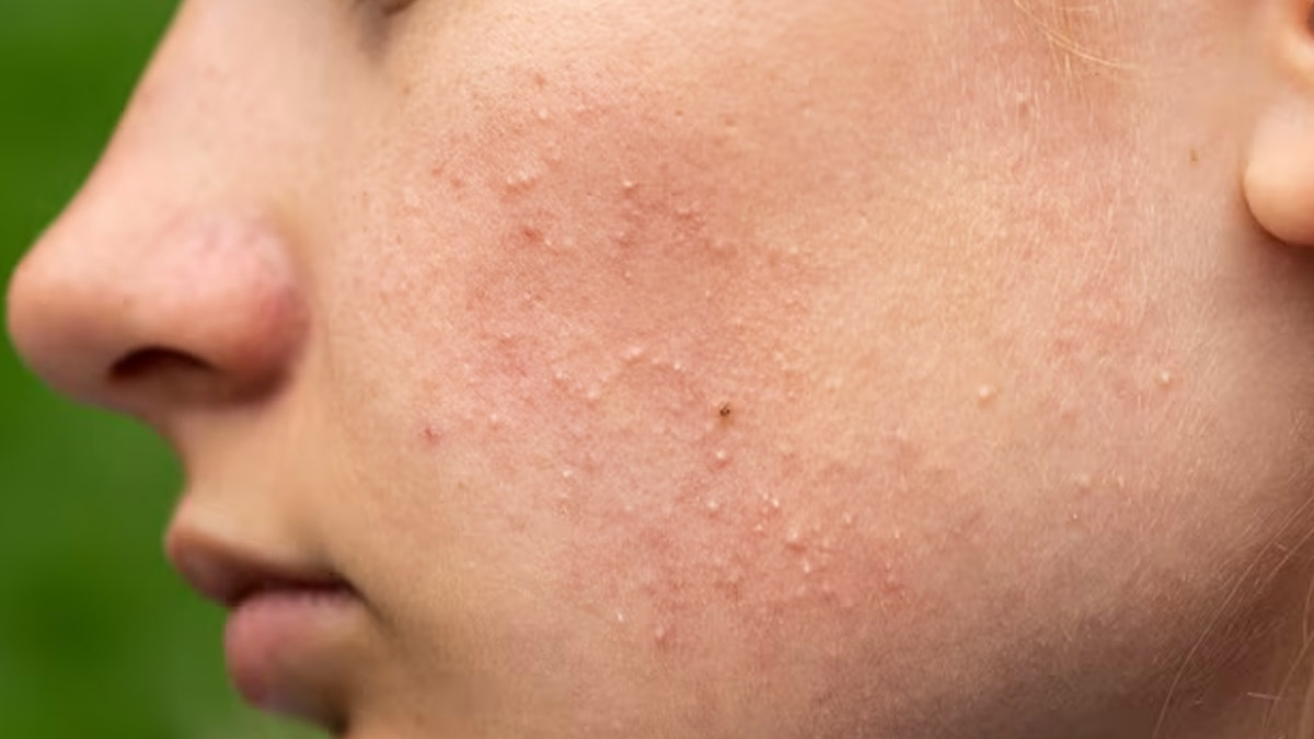 Understanding the Causes and Treatment of White Bumps on the Skin